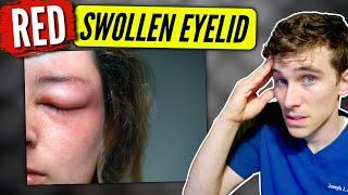 Swollen Eyelid: (causes & solutions) - Eye Doctor Explains