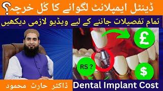 Dental Implant Cost in Pakistan | ڈینٹل ایمپلانٹ لگوانے کا کُل خرچہ | All you need to know