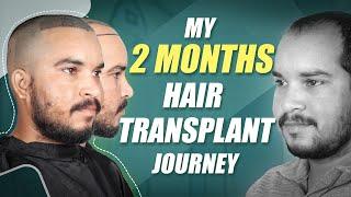 Hair Transplant in Jodhpur | Best Results & Cost of Hair Transplant in Jodhpur