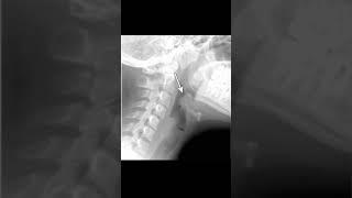 Epiglottitis #meded #ENT #infectiousdisease #emergencymedicine #medicine #criticalcare