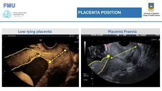 Basic Obstetrics Ultrasound - Dr Cladious Verenga