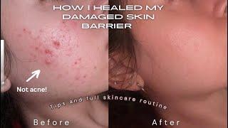 How I repaired my damaged skin barrier |Regular acne vs damaged skin |tips & product recommendations