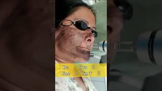 Carbon Laser / Hollywood facial in Zirakpur | The Skin Zeal | Dr. Isha V. Mittal | Call 7293939326