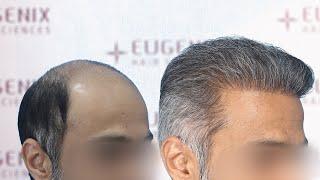 Hair Transplant Result | DHT /FUE | Before & After