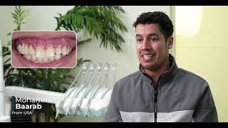 Overbite case treated with Zirconia Crowns  made his smile return [by Dentakay in Turkey]