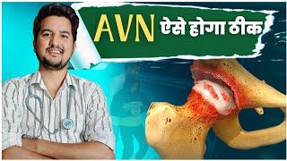 AVN WILL BE TREAT LIKE THIS - DR. AMIT BHARTI | AYURVEDIC AVN SPECIALIST