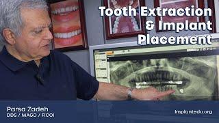 Same-Day Tooth Extraction & Implant: Step-by-Step (Part 2/4)