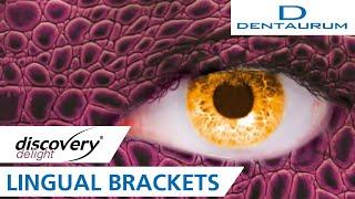 discovery® delight Lingual Brackets