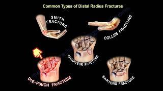 wrist fractures, symptoms, examination, diagnosis and treatment.