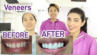 Smile Makeover With Dental Veneers By Celebrity Dentist | Team Glam