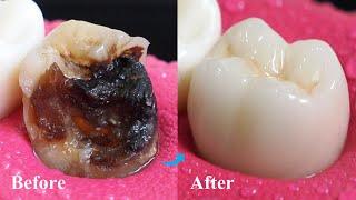 Incredible Restoration Of Tooth By Root Canal And Zirconia Crown.