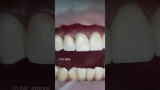 Smile Enhancement | Dr. Jibran