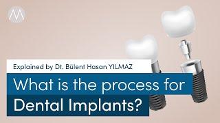 Process for Dental Implants - Explained by Dt. Bülent Hasan Yılmaz