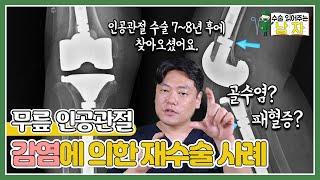 방치하다간 '패혈증'으로 이어질 수 있는 무릎 인공관절 감염에 의한 재수술 사례｜#무릎인공관절감염｜수술 읽어주는 남자‍️