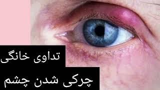 تداوی خانگی چشم دردی، چشم چرکی، گل مژه