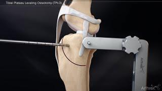 Tibial Plateau Leveling Osteotomy (TPLO)