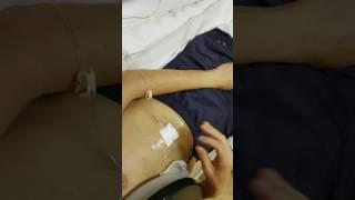 How to install a peritoneal port
