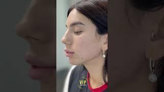 Jawline and Chin Contouring with Dr. ORO