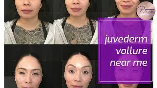 Juvederm near me Wisconsin