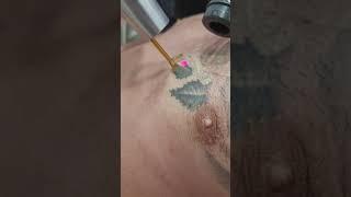 Tattoo removal at TazerLazer #tattooremoval #lasertattooremoval #tattooregret #picolaser #tazerlazer