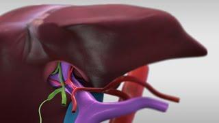 Living donor left lateral hepatectomy (Trailer) - TVASurg.ca