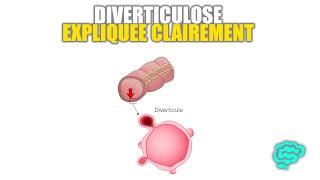  La Diverticulose Expliquée Très Clairement par Dr Astuce