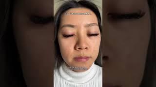 I flew to Korea to transform my skin, do you see a difference?
