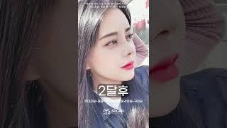 슈가성형외과 코성형 수술전~1년차까지