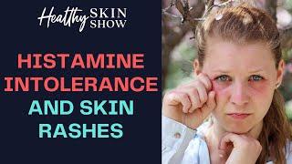 HISTAMINE Intolerance + Skin Rashes (PART 1) | Jennifer Fugo