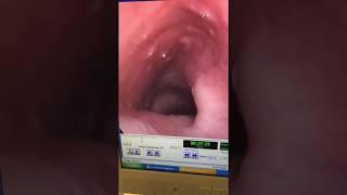 Dysfunction of the Belch Reflex: Visualized (Panendoscopy) + Cure (READ DESCRIPTION)