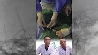 SAVE Technique for Mechanical Thrombectomy