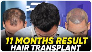 FUE Hair Transplant Results | Best Cost & Results of FUE Hair Transplant