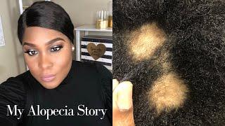 My Alopecia Story | Alopecia Areata