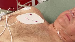 Non-Invasive Transcutaneous Pacing with the HeartStart Intrepid monitor/defibrillator