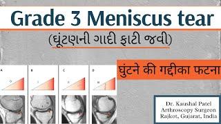 Grade 3 Meniscus tear on MRI #meniscustear #kneeinjury