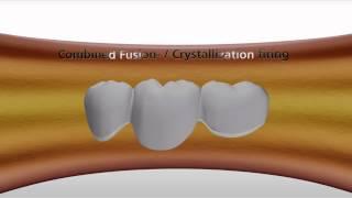 IPS e.max CAD-on English