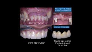 Cad Cam digital dentistry | Synergy Dental Care | Dr. Madhavi Mhapuskar | Pune