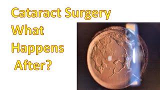 Cataract Surgery--What Happens Post Operation? (3/4)(4K)