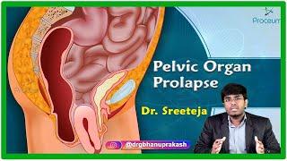 Pelvic Organ Prolapse || Gyeanacology