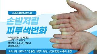 손발이 차고 저린데 창백하거나 파랗게 변할 때 레이노현상이란?