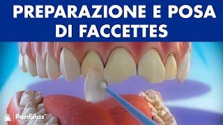 Faccette dentali - Preparazione e posa di faccettes ©