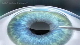 ReLEx SMILE Laser Vision Correction - Minimally Invasive Laser Eye Surgery