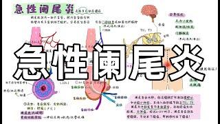 医学手绘  【急性阑尾炎】 | 病因机制+症状体征+诊断+治疗  Acute appendicitis | Causes + symptoms + diagnosis + treatment