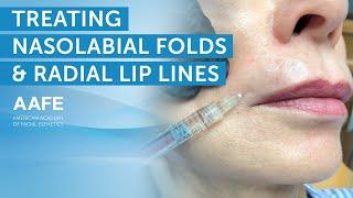 Treating Nasolabial Folds and Radial Lip Lines With Volbella