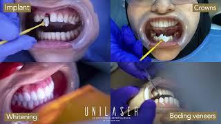 Smile Design, Crowns, Implants, Veneers in Medellin, Colombia.