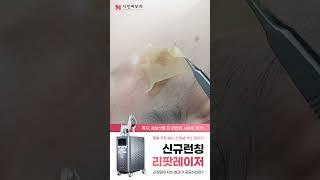 [리팟레이저 / 나인피부과] 흑자, 검버섯 단 한번의 시술로 치료 가능!