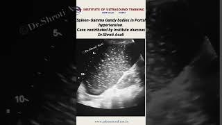 #GamnaGandy #spleen #portalhypertension #ultrasound #drrandhawainstitute #pocus