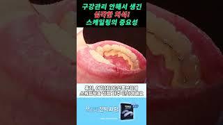 치석 대박 꼭 스케일링하셔야 합니다~ #Shorts