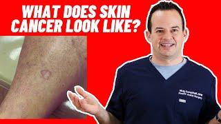 What does skin cancer look like? Dr.  Nick Campitelli | #shorts