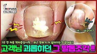 고객님을 끝없이 괴롭히던 그 발톱조각!! 박리증상이 점점 심해져서 찾아오셨어요  #레푸스 #레푸스일산 #발톱 #파고드는발톱 #ingrown_toenail #toenails